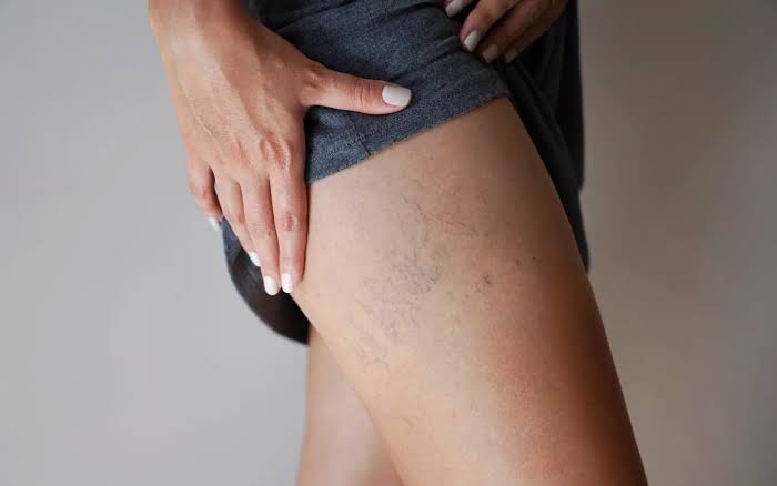 Varicose Veins: Symptoms, Causes, & Treatments